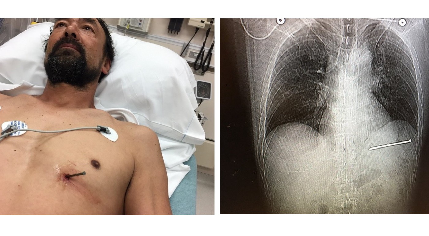 Se disparó un clavo en el pecho mientras trabajaba y manejó hasta el hospital | Internacionales