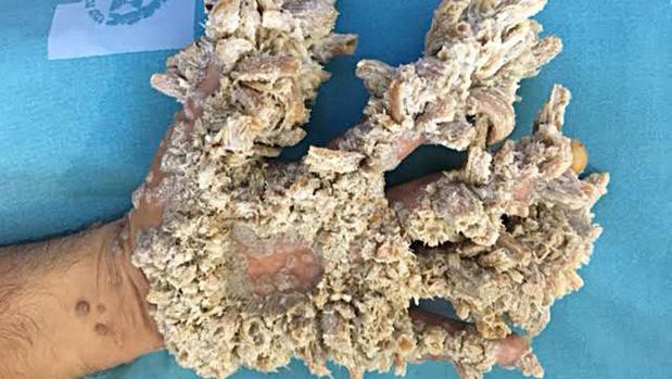 La historia del paciente que tiene pánico de volver a convertirse en el "hombre árbol" | Internacionales