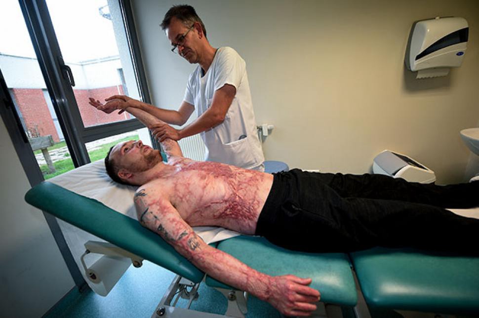 Tiene el 95% del cuerpo quemado y su hermano gemelo le donó el 50% de su piel | Internacionales