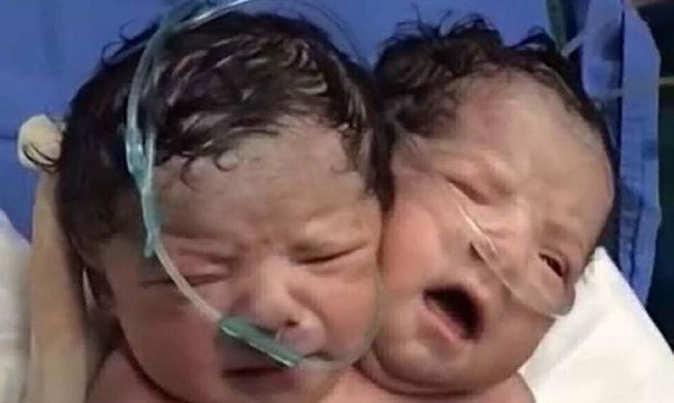 Dolor por la muerte de una de las siamesas "Esmeralda" | Internacionales