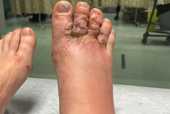 Una pareja viajó a República Dominicana y volvió con un parásito que "devoraba" sus pies | Internacionales