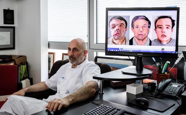 Trasplante inédito: el hombre de las tres caras | Internacionales