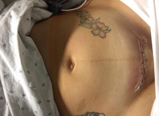 La mujer que se volvió viral por mostrar la cicatriz de su cesárea en Instagram | Redes