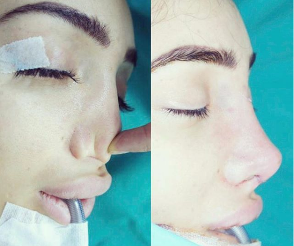 Se gastó 112.000 euros en una cirugía estética y terminó sin huesos en la nariz | Redes