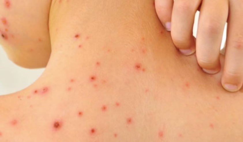 Brote de sarampión en México: registraron 9.074 casos, el mayor índice de América | Internacionales