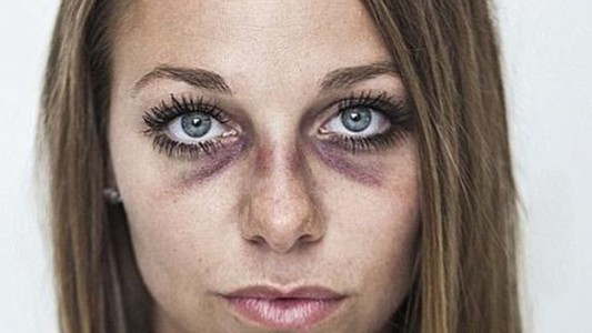 Tras recibir una paliza de su ex pareja mostró sus terribles heridas en Facebook para concientizar sobre la violencia doméstica