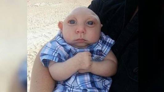 El bebé que nació con media cabeza sobrevivió y ya cumplió un año