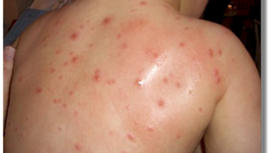 Murió un nene de 4 años afectado por varicela