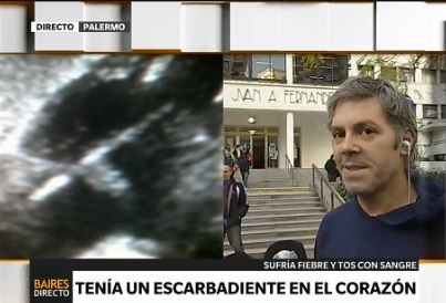 Paciente con un palillo en el corazón: "Me dieron vuelta el cuerpo tres veces"