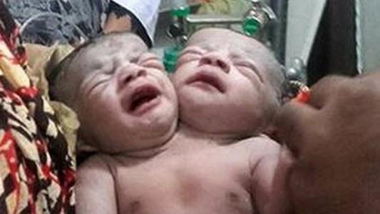 Bangladesh: conmoción por el nacimiento de una bebé con dos cabezas
