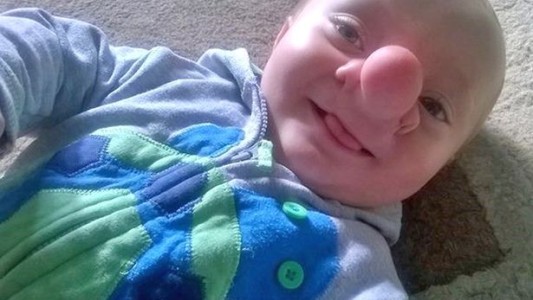 "Pinocho", el nene al que le crece el cerebro en la nariz