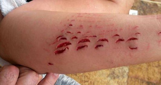 Así quedó una mujer atacada por un tiburón: "Me metería de nuevo a nadar mañana"