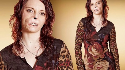 Mujer que perdió su nariz tras meningitis participará en un polémico show televisivo de citas