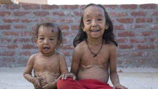 India: los hermanos que sufren la enfermedad de Benjamin Button
