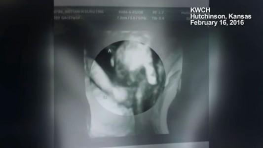 La asombrosa imagen de una ecografía muestra a un mellizo moribundo tomando la mano de su hermana