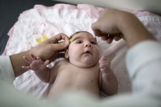 Brasil: más de 5.900 posibles casos de microcefalia relacionados con el zika