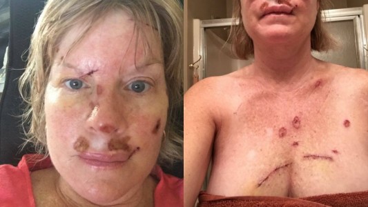 La mujer que mostró su lucha contra el cáncer de piel y conmocionó a las redes sociales