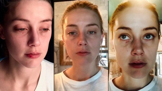 Aparecieron nuevas fotos de la ex esposa de Johnny Depp con golpes en la cara