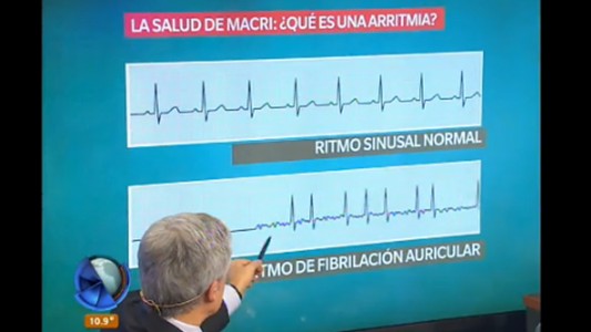 La salud de Macri: ¿qué es una arritmia?