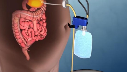 ¿El fin de la obesidad?: crearon una válvula que extrae la comida directamente del estómago