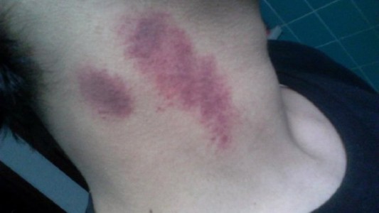 Un joven murió por el beso de su novia