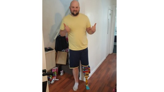La historia del hombre que construyó su prótesis con piezas de LEGO