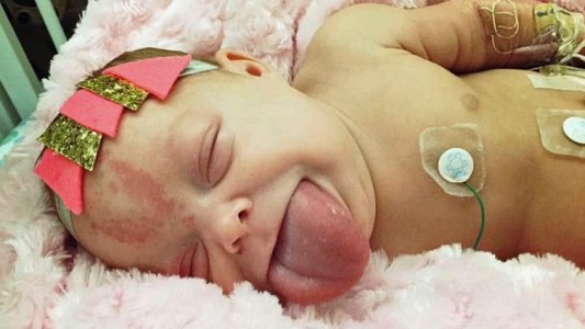 El increíble caso de la bebé que nació con la lengua de un adulto
