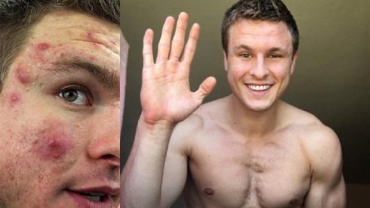 La historia del joven que venció al acné