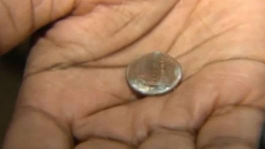 Un bebé pasó 37 días con una moneda en el cuerpo sin que los médicos se dieran cuenta