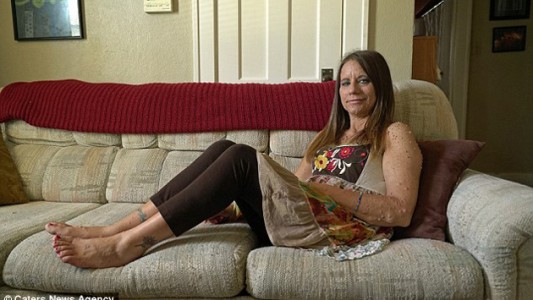 El calvario de la mujer que vive con casi 6.000 tumores en el cuerpo