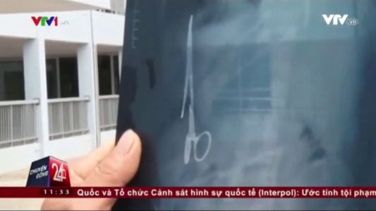 Lo operaron para sacarle una pinza quirúrgica olvidada en su estómago hace 18 años