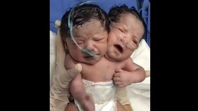 México: murió el bebé con dos cabezas