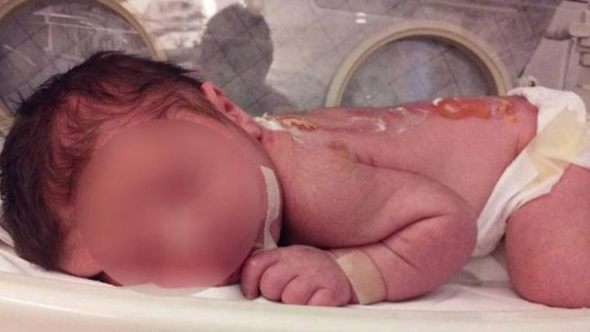 Córdoba: Bebé recién nacido sufrió quemaduras en una clínica