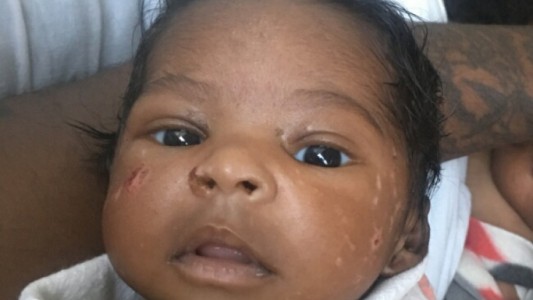 Este bebé perdió casi toda su piel y sus padres no pueden ni siquiera acariciarlo