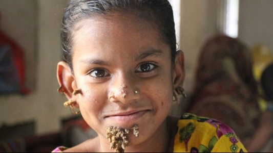 Dramático: a una nena de 10 años  diagnosticaron la "enfermedad del hombre árbol"