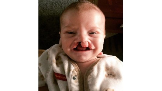 Donante anónimo pagó la operación para un bebé con labio leporino porque se reían de él en internet