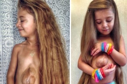 El extraño caso de la nena que nació con el corazón fuera del pecho