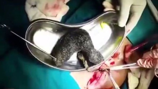 La increíble bola de pelo que sacaron del estómago de un paciente