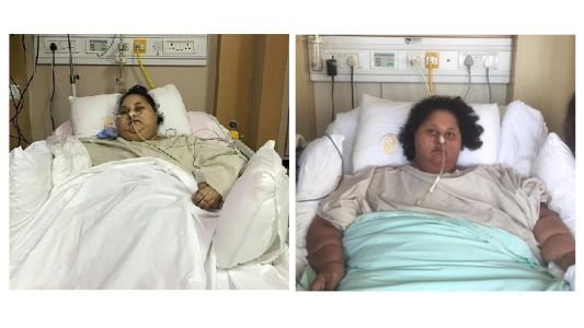 Mujer operada regresa a la India con 300 kilos menos