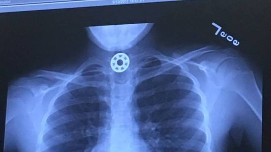 Salvaron a una nena de morir asfixiada luego de tragarse una pieza del juguete de moda