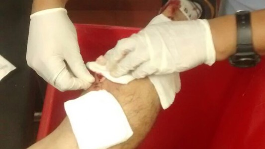 Le cosieron la pierna sobre un tacho de residuos hospitalarios