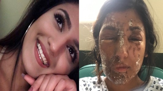 Le desfiguraron el rostro con ácido y sus amigos juntan dinero para la operación