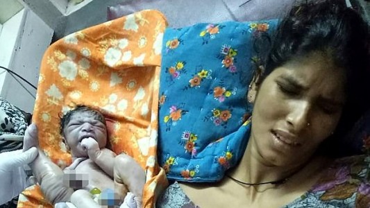 India: el bebé que nació con cuatro piernas y dos penes