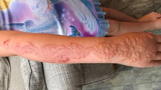 Nena de 7 años sufrió graves quemaduras al realizarse un tatuaje de henna