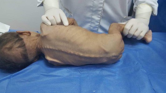 Diputado venezolano reportó la muerte por desnutrición de un niño