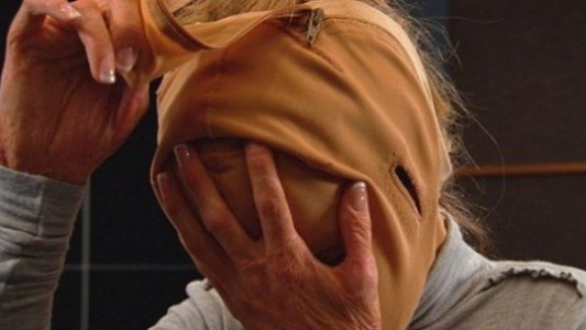 La increíble transformación de la mujer a la que le quemaron 60% del cuerpo