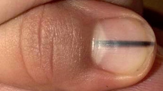 Fue a la manicurista y le descubrió cáncer