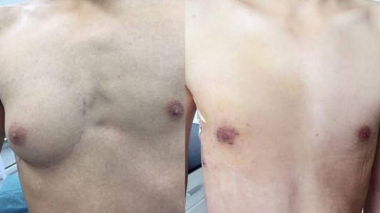 El curioso caso del joven chino al que le creció un pecho