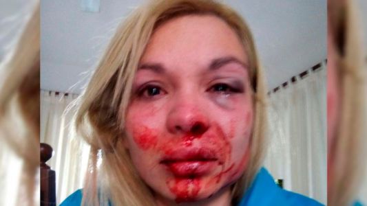 Una personal trainer sufrió una brutal golpiza de su pareja: "Me quiso tirar por las escaleras"