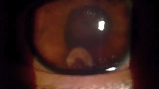 Impresionante: Le molestaba el ojo y descubrieron que tenía un gusano que se lo estaba comiendo